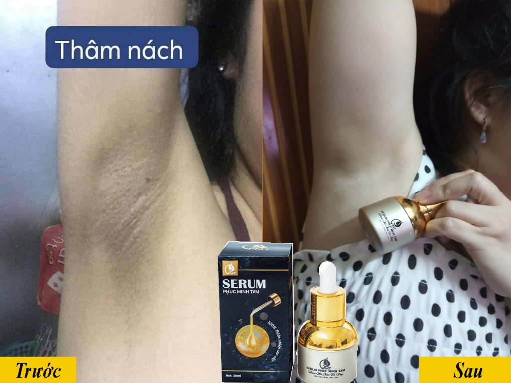 serum trị thâm phúc minh tâm khách feedback thâm nách