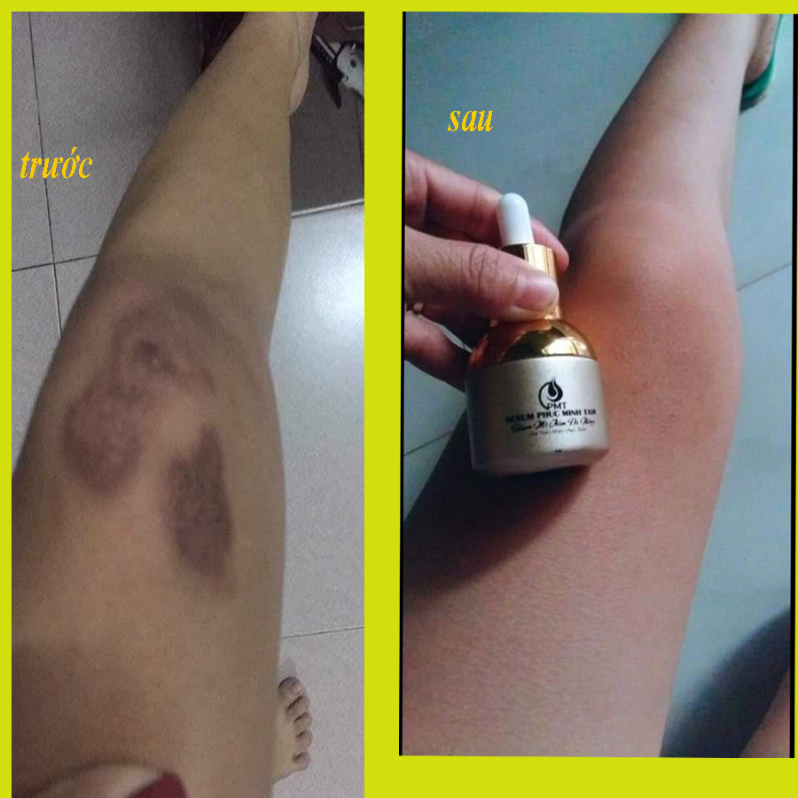 Trị thâm pmt-serum trị thâm phúc minh tâm khách feedback thâm đầu gối