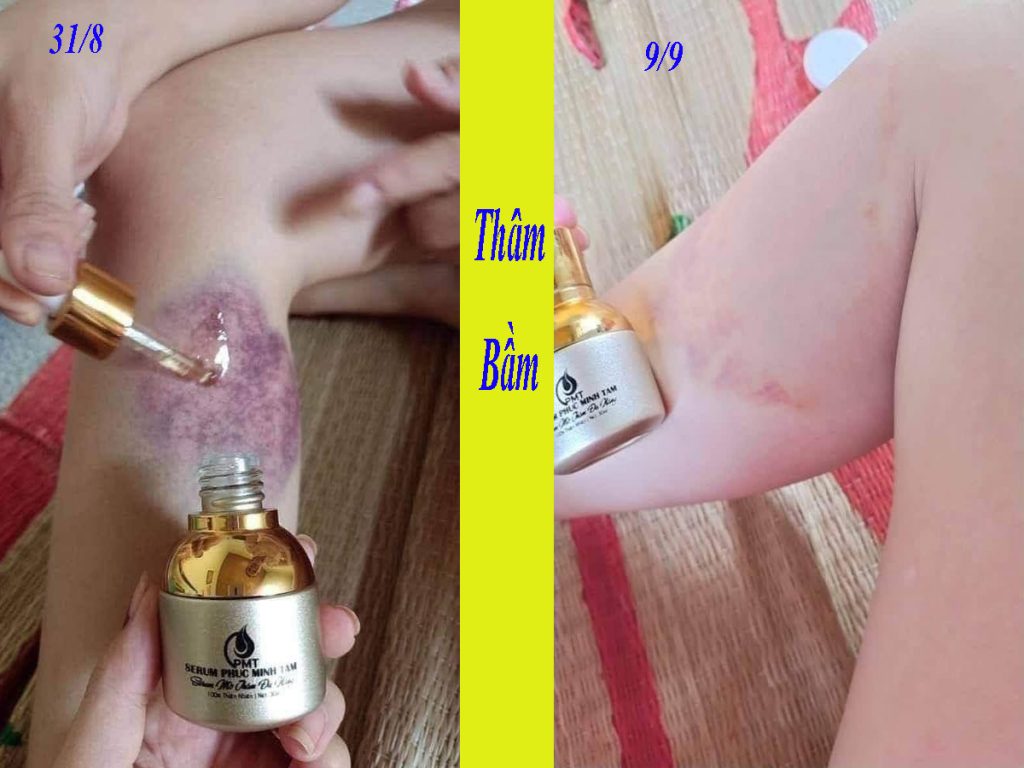 trị thâm pmt