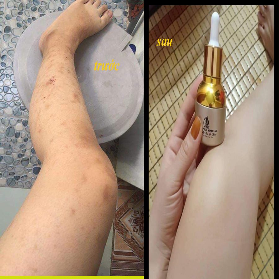serum phúc minh tâm t-trị thâm pmt rị thâm giảm ngứa