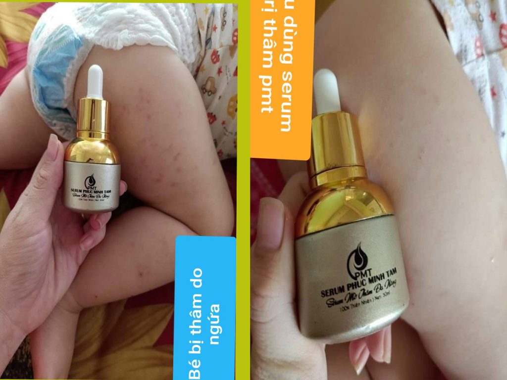 trị thâm pmt phúc minh tâm