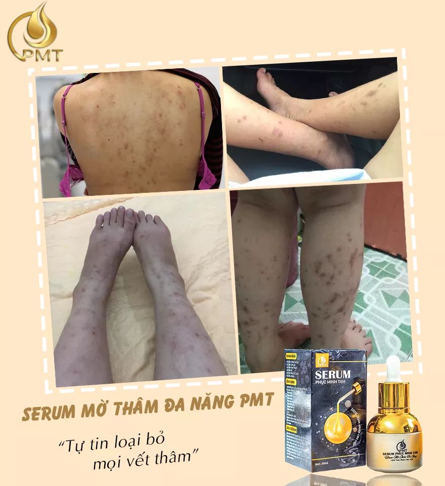 review chi tiết serum trị thâm pmt phúc minh tâm