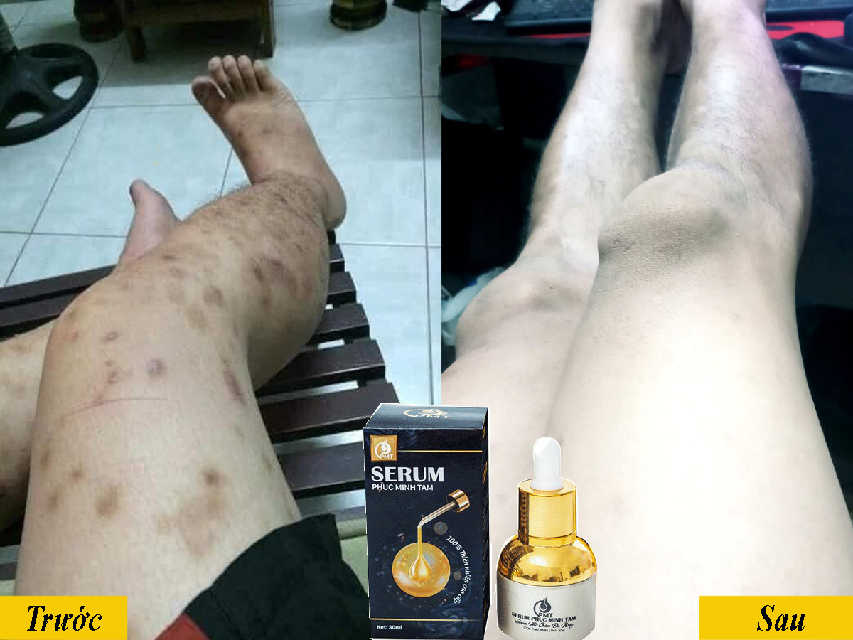 trị thâm pmt trị sạch thâm chân